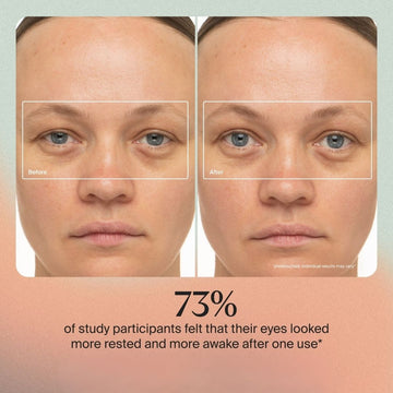 Nuvio Depuffing-staf